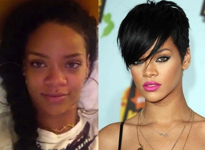 Plastic Surgery Rihanna Lips